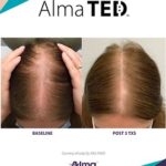 Before and after of hair restoration with Alma