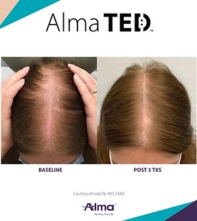 Before and after of hair restoration with Alma