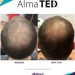 Hair Restoration before and after by Dr. Eric