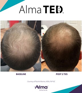 Hair Restoration before and after by Dr. Eric